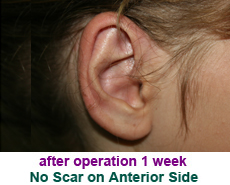 plastic-surgery-prominent-ear 